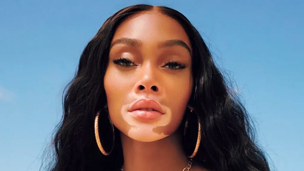 Winnie Harlow Age, Height, Affairs, Net Worth, Husband, Kids And More