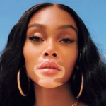 Winnie Harlow Age, Height, Affairs, Net Worth, Husband, Kids And More