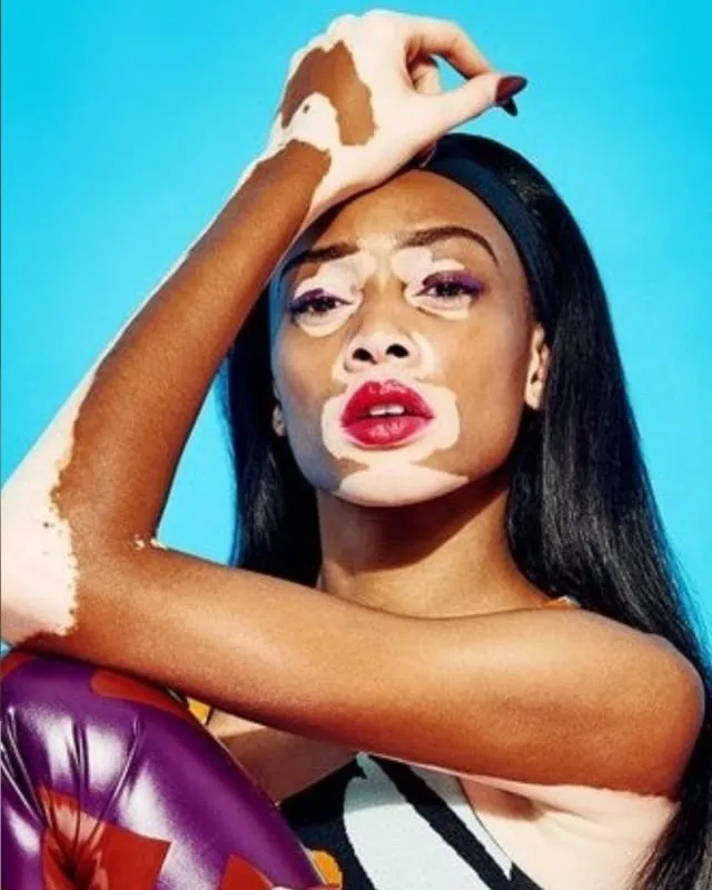 Winnie Harlow Age, Height, Affairs, Net Worth, Husband, Kids And More