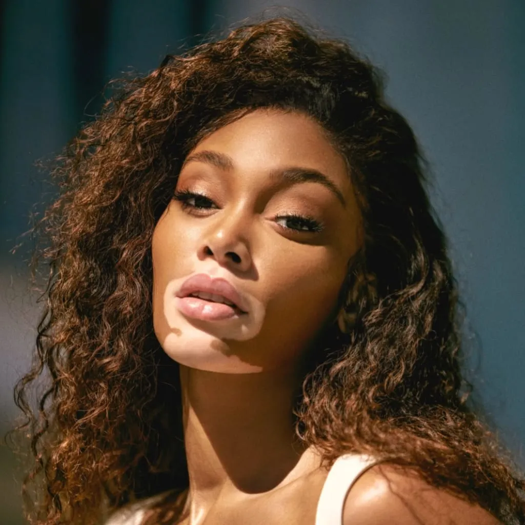 Winnie Harlow Age, Height, Affairs, Net Worth, Husband, Kids And More